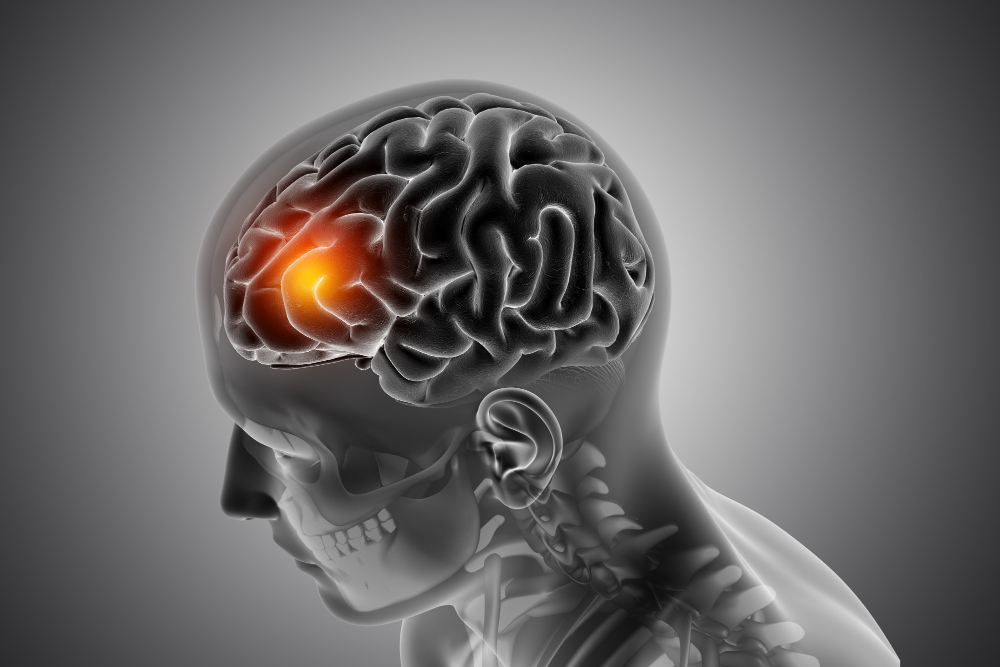  Traumatic Brain Injuries (TBIs)