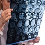 Traumatic Brain Injuries