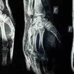 X-ray showing detailed view of hand bones representing fracture injury claims