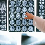 Radiologist examining brain MRI scans representing traumatic brain injury diagnosis